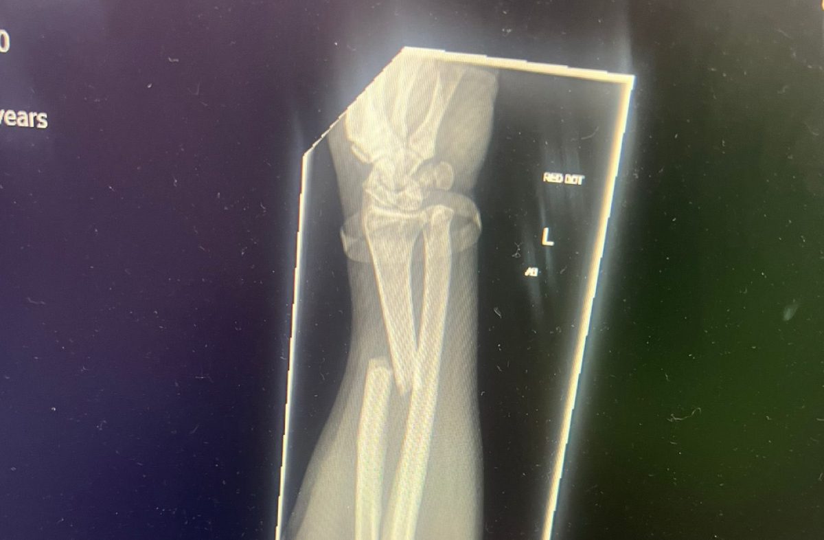 Battling the Elements: Isle of Man TT Rider Faces Unlikely Obstacle in Gull-Inflicted Injury